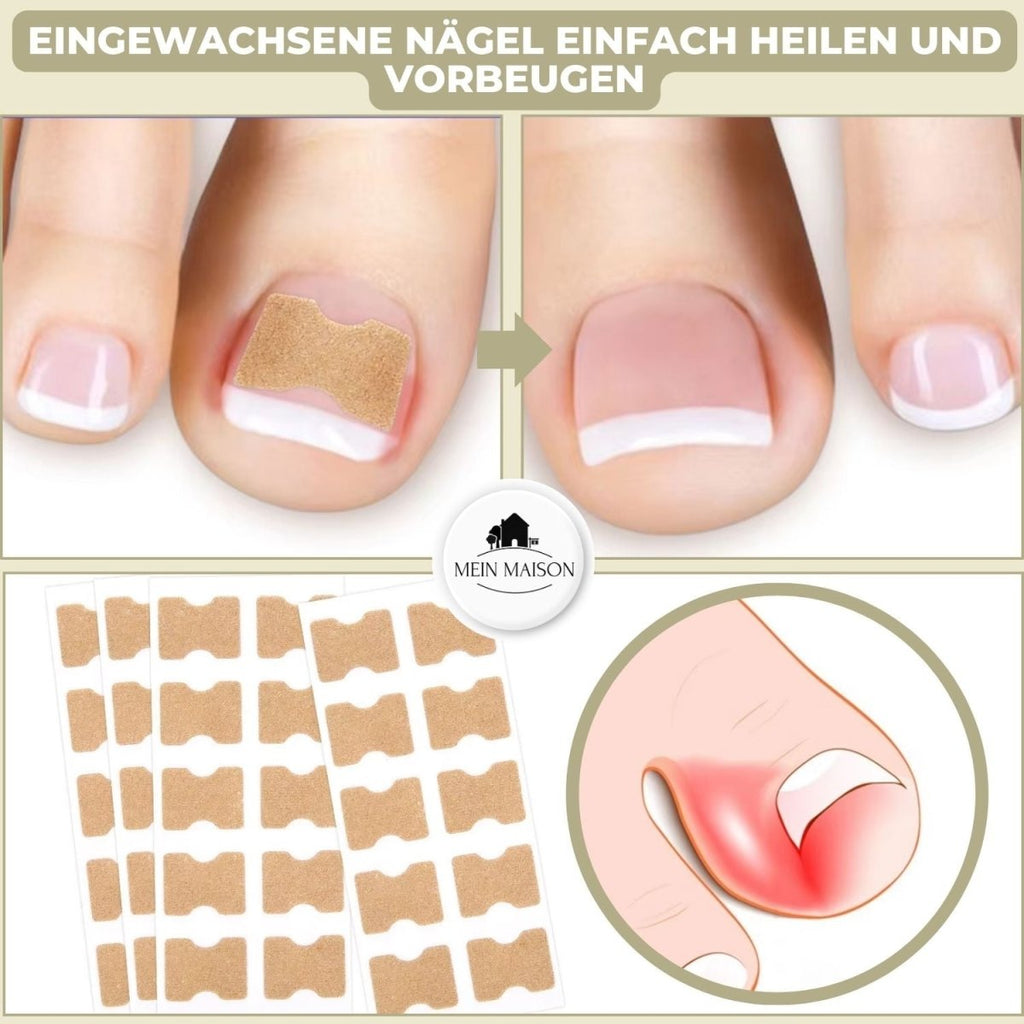 Nail Correction Strips for Ingrown and Deformed Nails, 10 Count, view 2