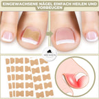 Nail Correction Strips for Ingrown and Deformed Nails, 10 Count, view 2